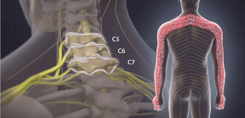 radiculitis caused by neck vertebrae