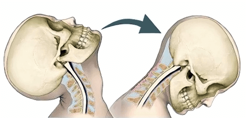 whiplash causes neck pain