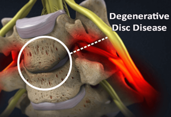 What are some symptoms of degenerative disc disease in the thoracic spine?