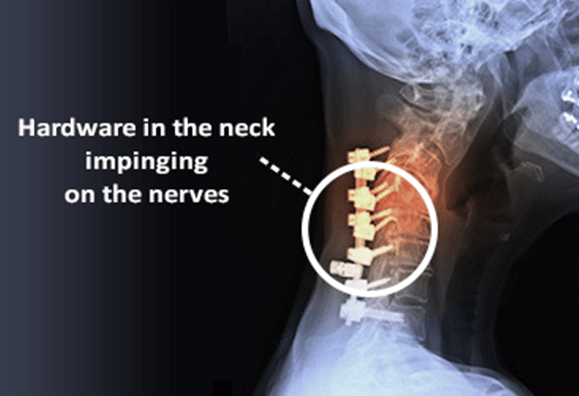 What are the symptoms of a failed cervical fusion?