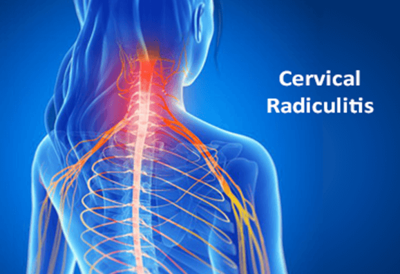 cervical radiculitis