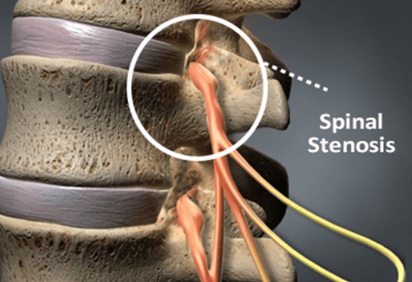 spinal stenosis