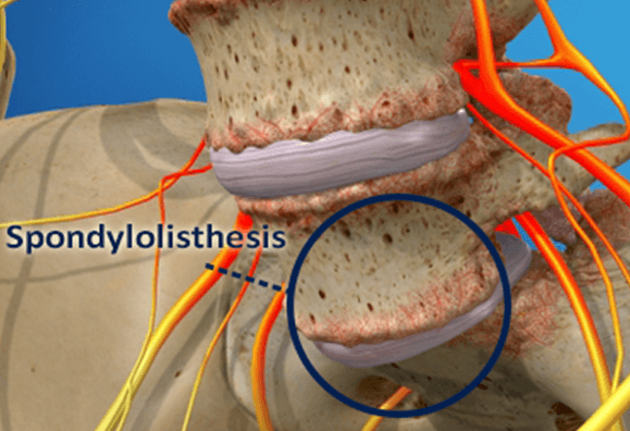 spondylolisthesis