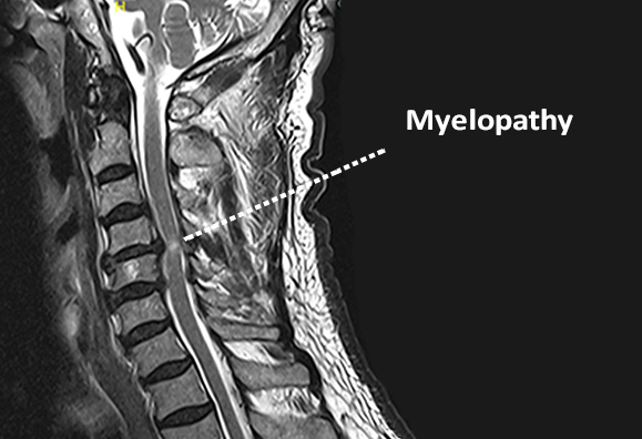 myelopathy