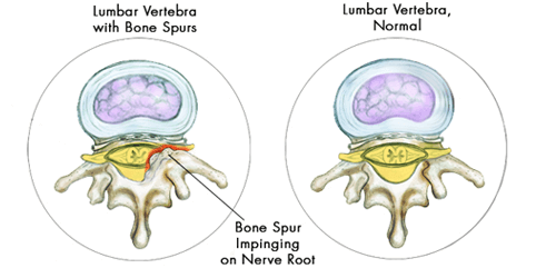 what causes bone spurs