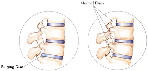 Bulging Disc Causes