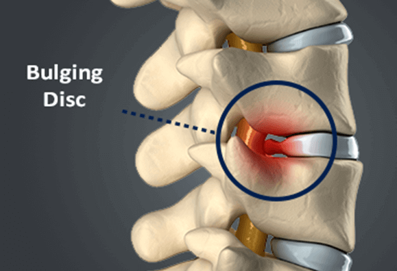 Bulging Disc - Causes, Symptoms & Treatment