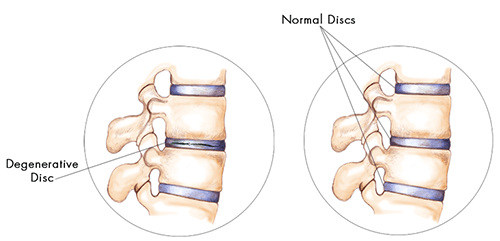 degenerative disc disease causes