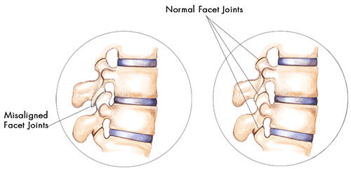 Thoracic Spine Facet Irritation