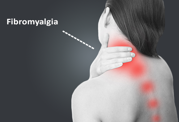 fibromyalgia illustration