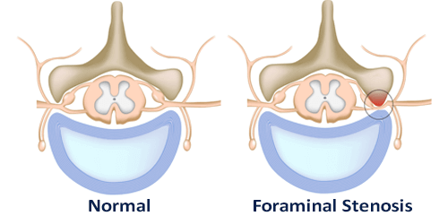 cause of foraminal stenosis illustrated