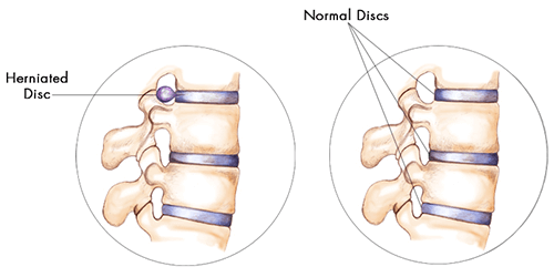 Slipped (Herniated) Disc - Causes and Symptoms