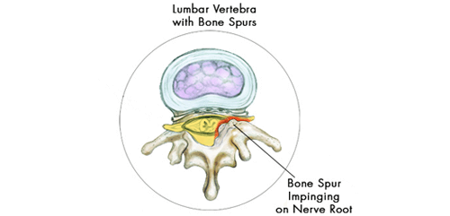 pinched nerve caused by bone spur