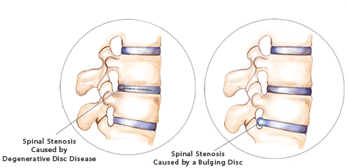 spinal stenosis causes