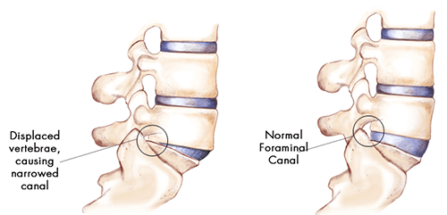 vertebrae causing spondylolisthesis