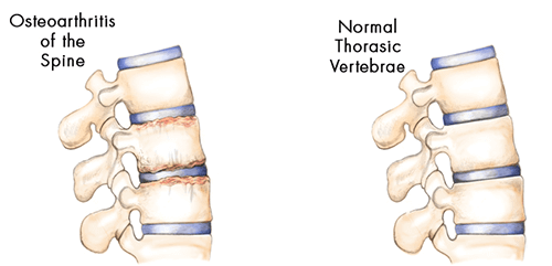 Spondylosis causes