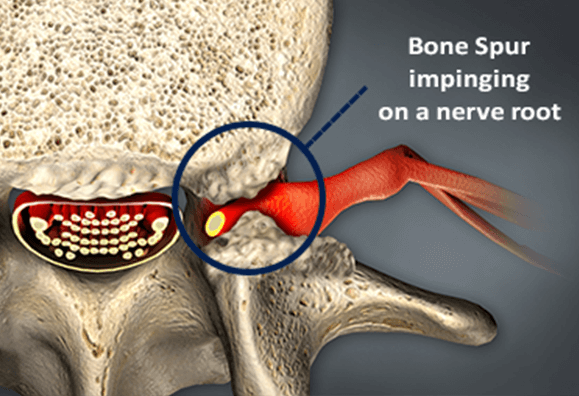 bone spur on nerve