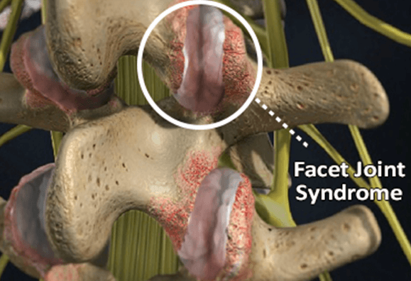 facet joint syndrome