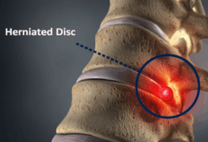herniated disc