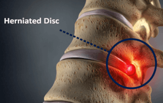 herniated disc