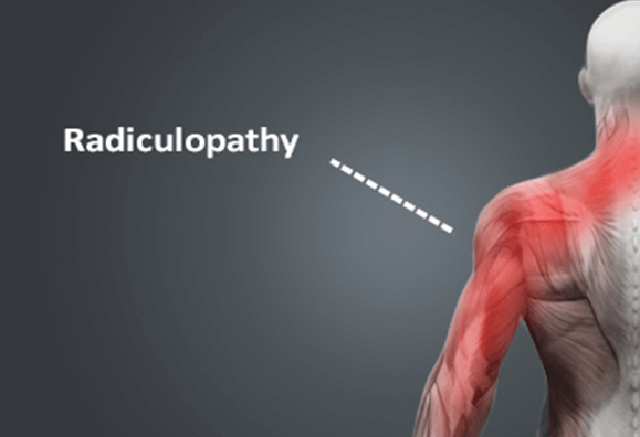 Cervical Radiculopathy (Pinched Nerve in Neck): Symptoms & Treatment