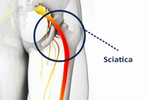 sciatica illustration