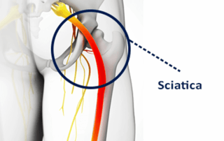 sciatica illustration