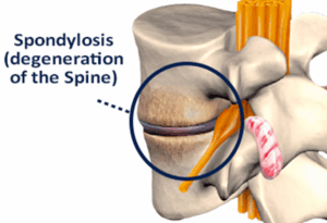 spondylosis (degeneration of the spine)