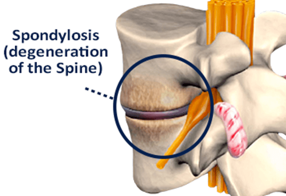 spondylosis