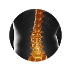 Failed Back Surgery Syndrome Xray