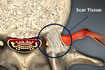 Scar Removal Surgery for Spinal Fusion Patients