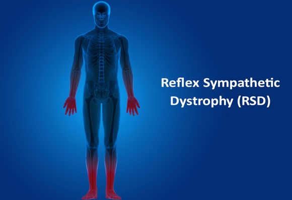 reflex sympathetic dystrophy