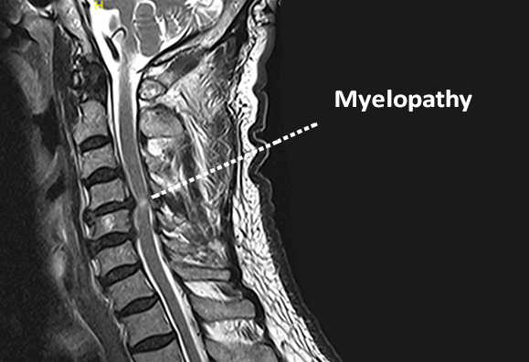 Myelopathy  Johns Hopkins Medicine