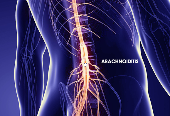 arachnoiditis