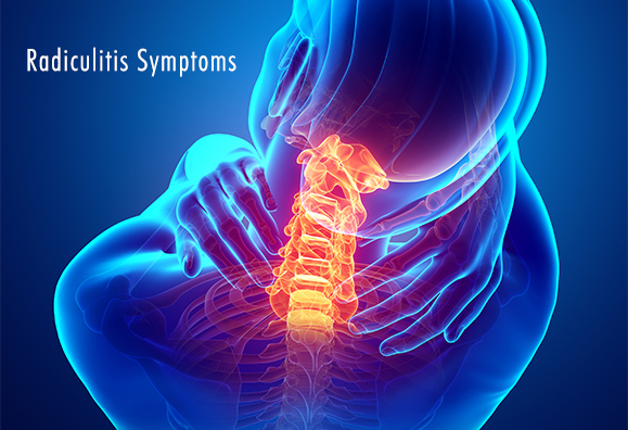 radiculitis symptoms