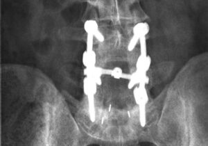 failed back surgery recovery