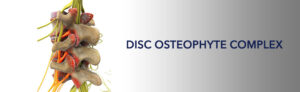 Disc Osteophyte Complex in Vertebral Column