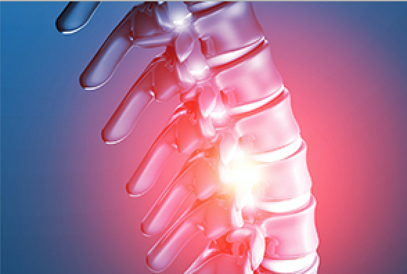 Lumbar osteophytes 