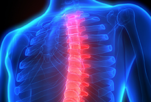 thoracic osteophytes 