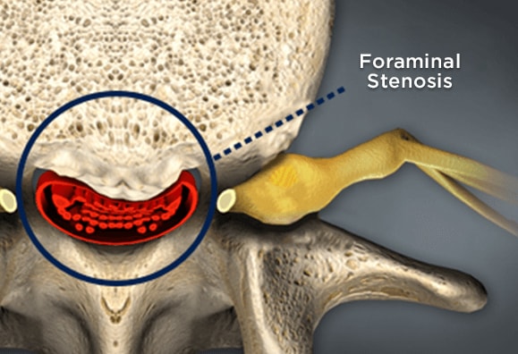 Foraminal Stenosis