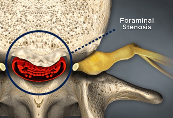 Foraminal Stenosis: What It Is, Symptoms, Types & Treatments