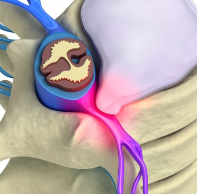 Herniated Disc: Causes, Symptoms & Treatment