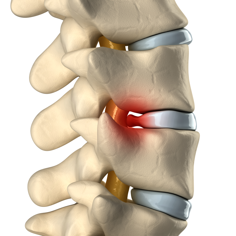 Slipped Disc - Causes, Symptoms & Treatment