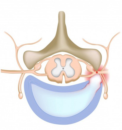 ruptured disc in the spine