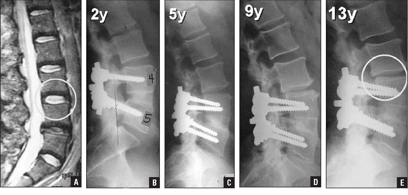 Adjacent Segment Disease