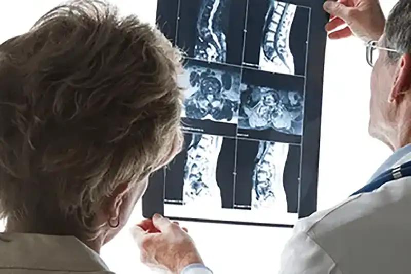 Spine Surgeons Consider Bone Spur Treatment in Hudson & Tampa, FL