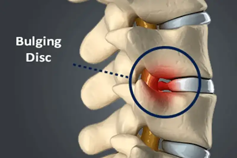 Illustration of a Bulging Disc in Hudson & Tampa Bay, FL