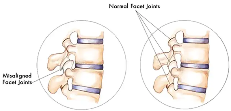 Causes of Facet Syndrome in Hudson & Tampa, FL