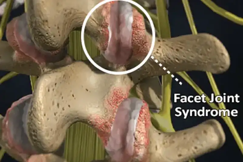 Facet Joint Syndrome Treatment in Hudson & Tampa, FL