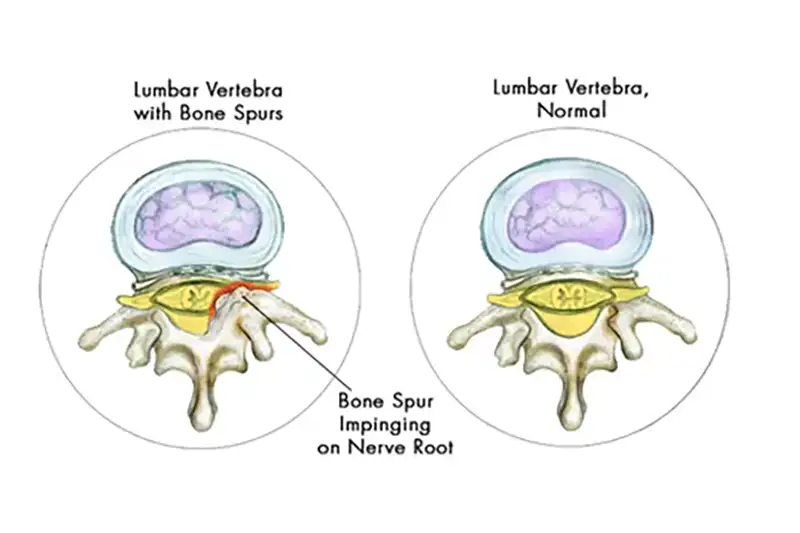 bone-spur-causes